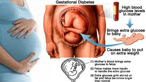 Cara Elakkan Diabetes Semasa Mengandung (GDM)