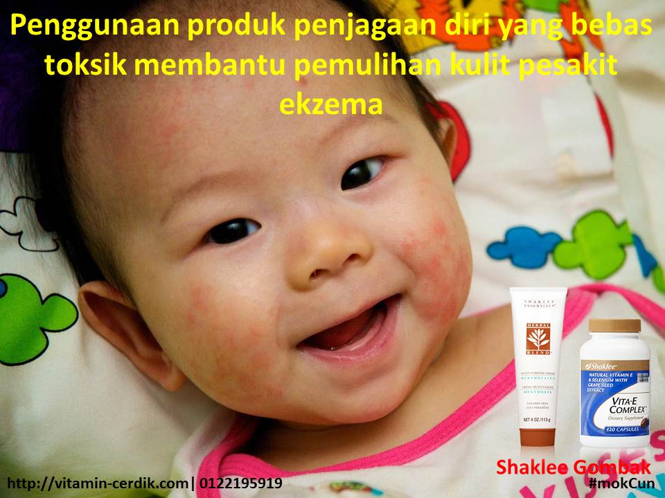Bayi untuk ubat eczema Eksema Tiada