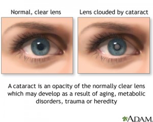 Katarak Mata merupakan masalah kesihatan mata