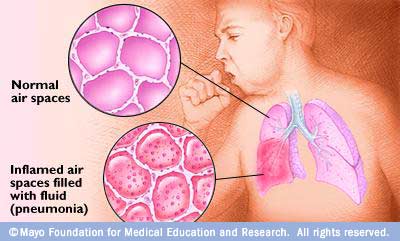 Perbezaan paru-paru sihat dengan paru-paru dengan pneumonia
