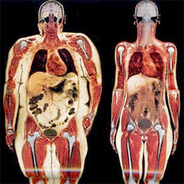 Subcutoneous fat adalah lemak bawah kulit, ramai orang yang nampak gemuk adalah tinggi dalam subcutoneous fat