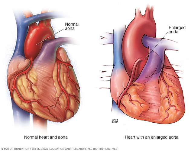 Keadaan normal aorta dan aorta apabila ia pecah