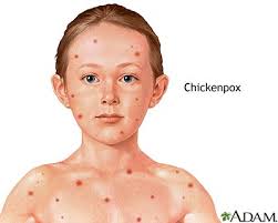 Hilangkan Parut Chicken Pox Dalam 7 Hari