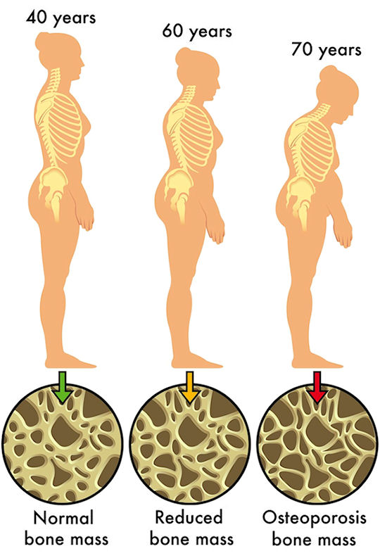 Bongkok merupakan satu tanda anda mempunyai osteoporosis