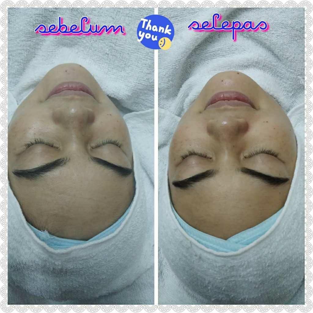 testimoni facial botg