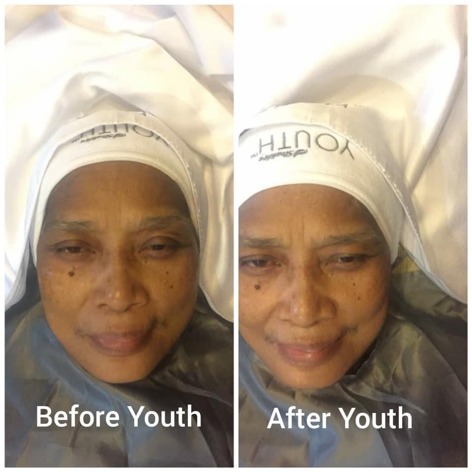 testimoni facial botg