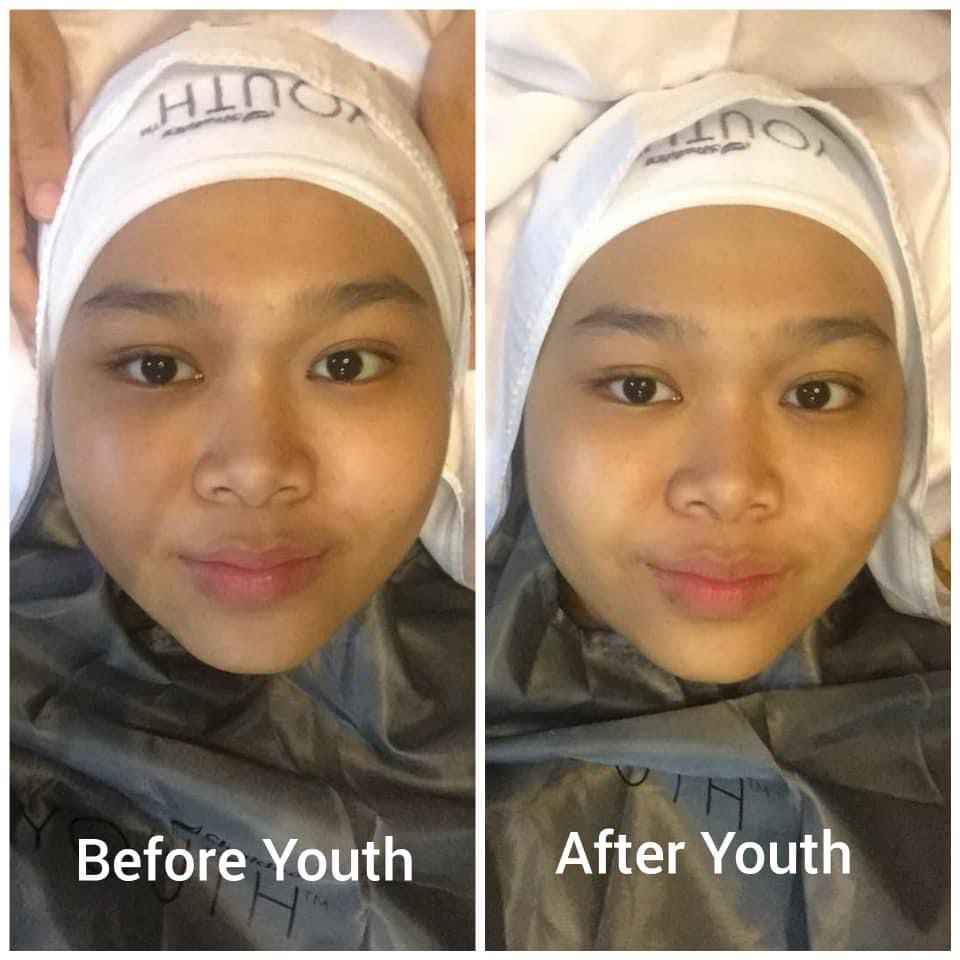 testimoni facial botg