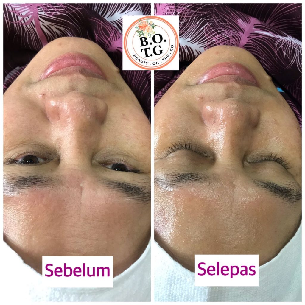 testimoni facial botg